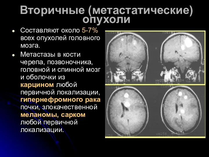 Вторичные (метастатические) опухоли Составляют около 5-7% всех опухолей головного мозга. Метастазы