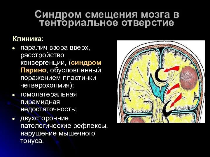 Синдром смещения мозга в тенториальное отверстие Клиника: паралич взора вверх, расстройство