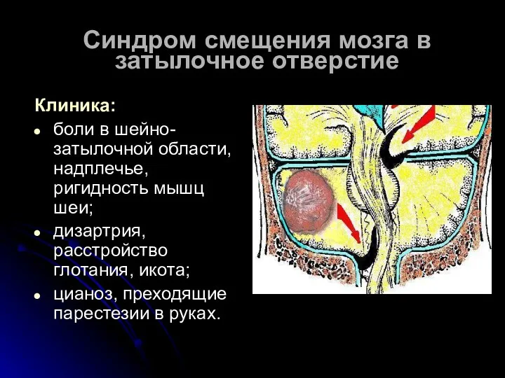 Синдром смещения мозга в затылочное отверстие Клиника: боли в шейно-затылочной области,