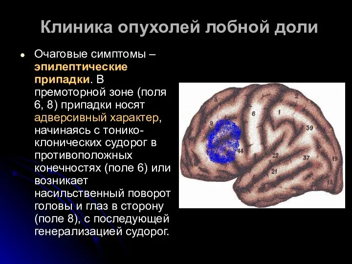 Клиника опухолей лобной доли Очаговые симптомы – эпилептические припадки. В премоторной