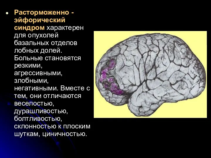 Расторможенно - эйфорический синдром характерен для опухолей базальных отделов лобных долей.