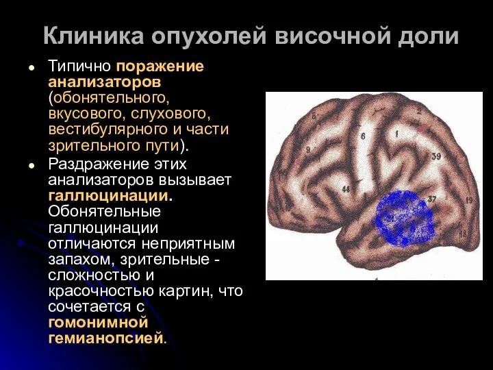 Клиника опухолей височной доли Типично поражение анализаторов (обонятельного, вкусового, слухового, вестибулярного