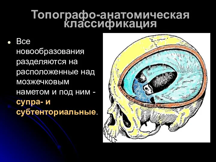 Топографо-анатомическая классификация Все новообразования разделяются на расположенные над мозжечковым наметом и