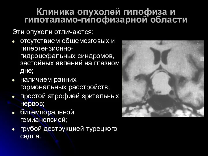 Клиника опухолей гипофиза и гипоталамо-гипофизарной области Эти опухоли отличаются: отсутствием общемозговых