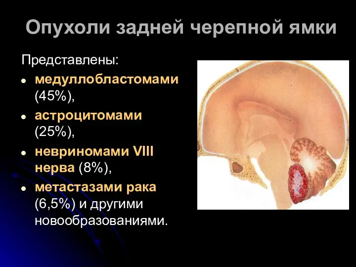 Опухоли задней черепной ямки Представлены: медуллобластомами (45%), астроцитомами (25%), невриномами VIII