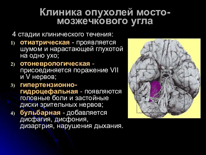 Клиника опухолей мосто-мозжечкового угла 4 стадии клинического течения: отиатрическая - проявляется