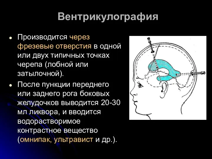 Вентрикулография Производится через фрезевые отверстия в одной или двух типичных точках