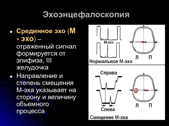 Эхоэнцефалоскопия Срединное эхо (М - эхо) – отраженный сигнал формируется от