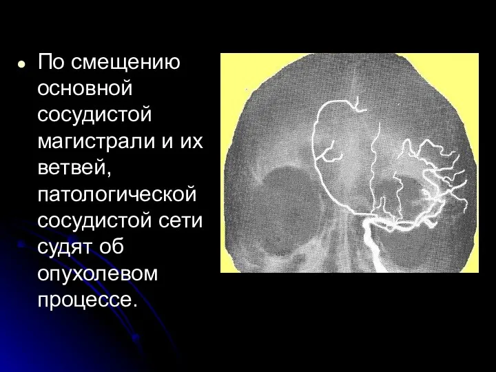 По смещению основной сосудистой магистрали и их ветвей, патологической сосудистой сети судят об опухолевом процессе.