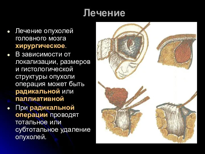 Лечение Лечение опухолей головного мозга хирургическое. В зависимости от локализации, размеров