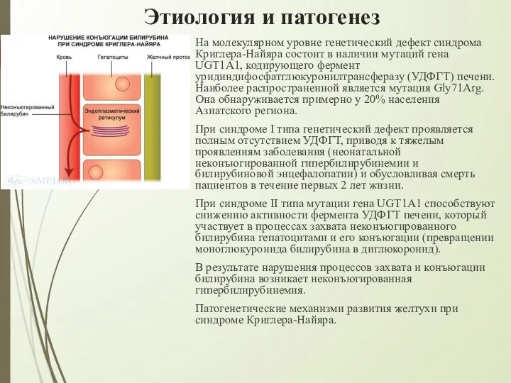 Этиология и патогенез На молекулярном уровне генетический дефект синдрома Криглера-Найяра состоит