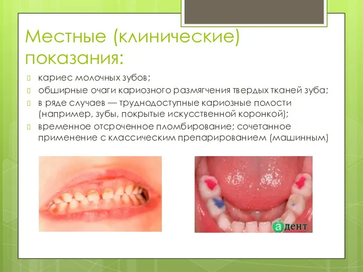 Местные (клинические) показания: кариес молочных зубов; обширные очаги кариозного размягчения твердых