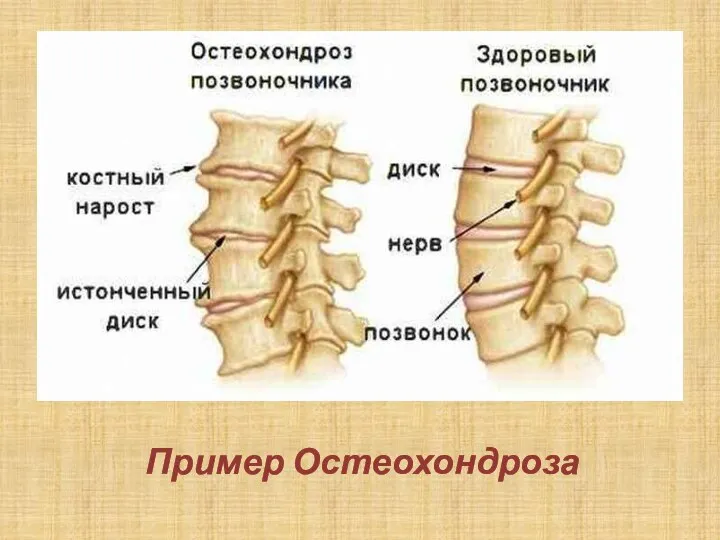 Пример Остеохондроза