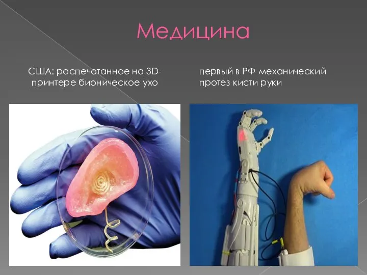 Медицина США: распечатанное на 3D-принтере бионическое ухо первый в РФ механический протез кисти руки