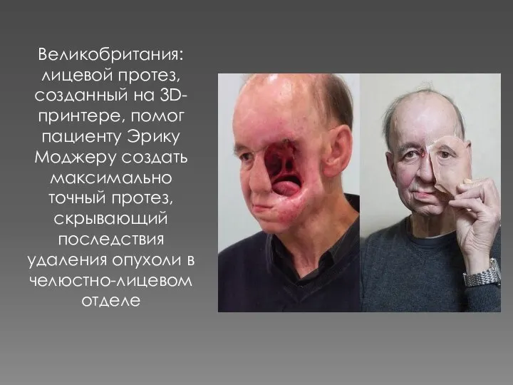 Великобритания: лицевой протез, созданный на 3D-принтере, помог пациенту Эрику Моджеру создать