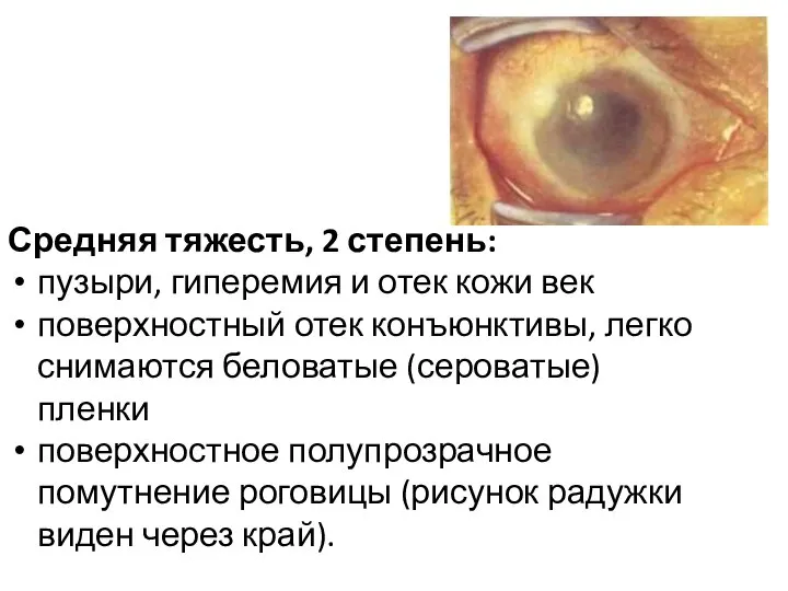 Средняя тяжесть, 2 степень: пузыри, гиперемия и отек кожи век поверхностный