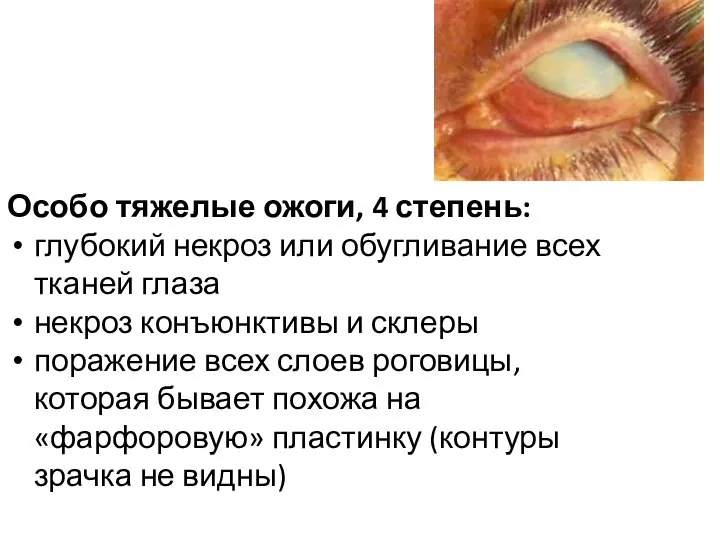 Особо тяжелые ожоги, 4 степень: глубокий некроз или обугливание всех тканей