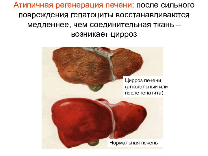 Атипичная регенерация печени: после сильного повреждения гепатоциты восстанавливаются медленнее, чем соединительная