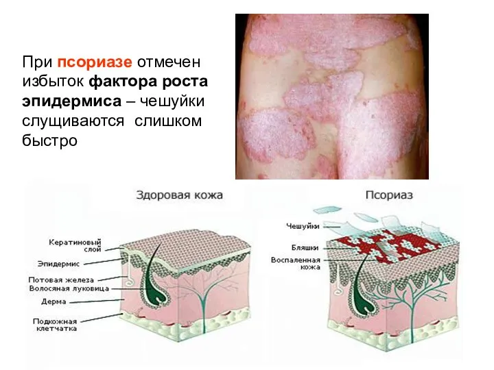 При псориазе отмечен избыток фактора роста эпидермиса – чешуйки слущиваются слишком быстро