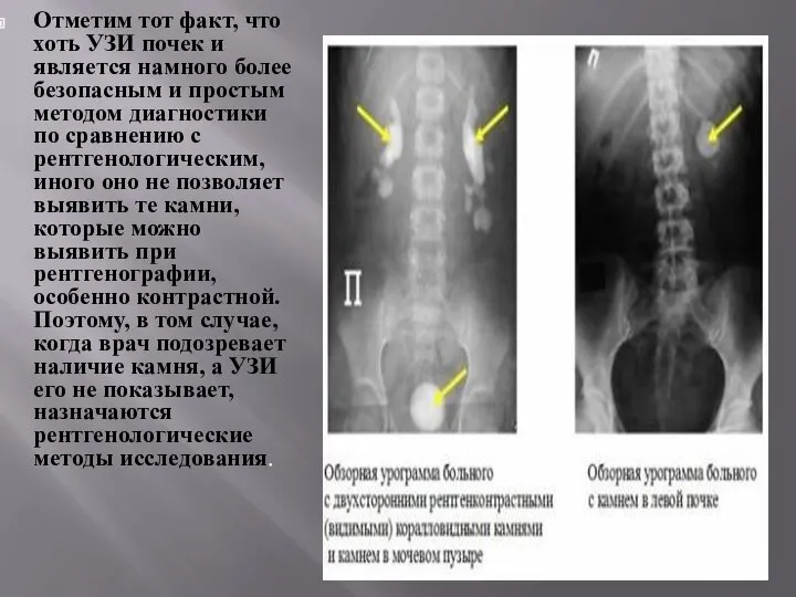 Отметим тот факт, что хоть УЗИ почек и является намного более