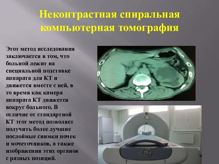 Неконтрастная спиральная компьютерная томография Этот метод исследования заключается в том, что