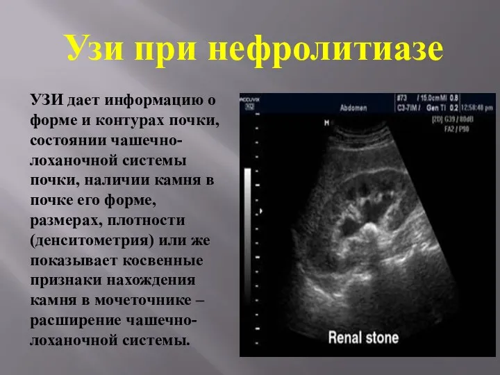 Узи при нефролитиазе