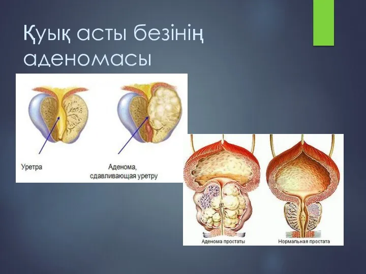 Қуық асты безінің аденомасы