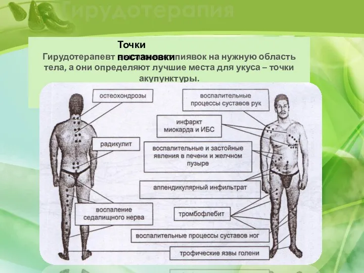 Гирудотерапия Гирудотерапевт высаживает пиявок на нужную область тела, а они определяют