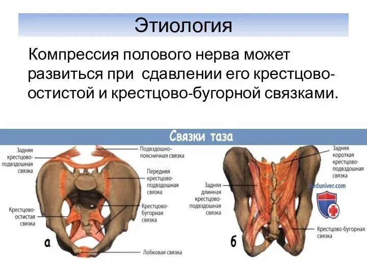 Этиология Компрессия полового нерва может развиться при сдавлении его крестцово-остистой и крестцово-бугорной связками.