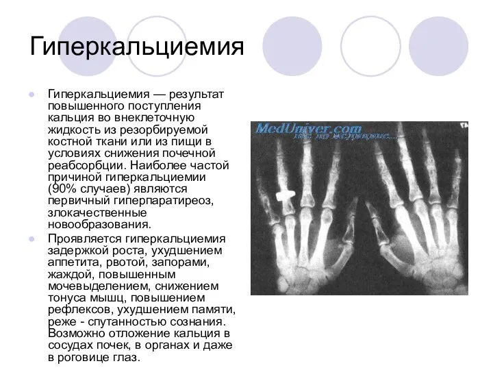 Гиперкальциемия Гиперкальциемия — результат повышенного поступления кальция во внеклеточную жидкость из