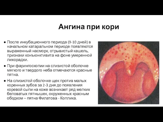Ангина при кори После инкубационного периода (9-10 дней) в начальном катаральном