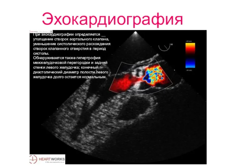 Эхокардиография При эхокардиографии определяется утолщение створок аортального клапана, уменьшение систолического расхождения
