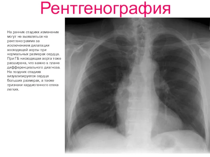 Рентгенография На ранних стадиях изменения могут не выявляться на рентгенограмме за