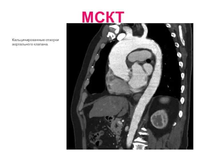 МСКТ Кальцинированные створки аортального клапана.
