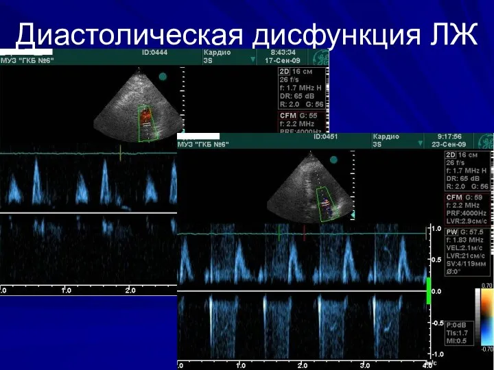 Диастолическая дисфункция ЛЖ