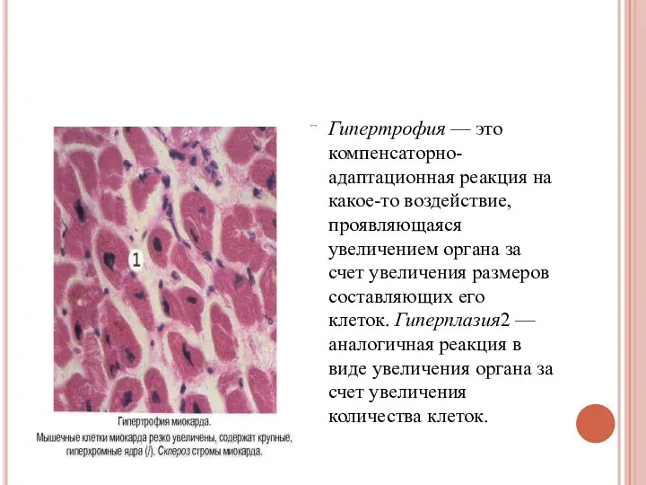 Гипертрофия — это компенсаторно-адаптационная реакция на какое-то воздействие, проявляющаяся увеличением органа