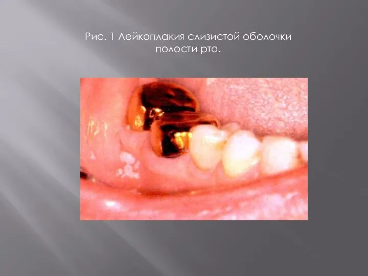 Рис. 1 Лейкоплакия слизистой оболочки полости рта.