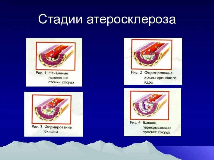 Стадии атеросклероза