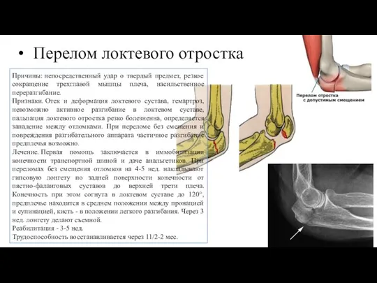 Перелом локтевого отростка Причины: непосредственный удар о твердый предмет, резкое сокращение