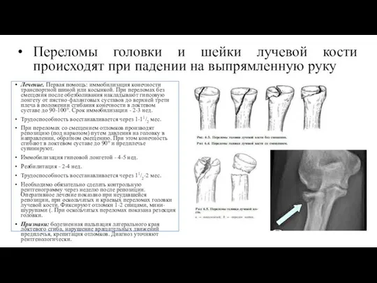 Лечение. Первая помощь: иммобилизация конечности транспортной шиной или косынкой. При переломах