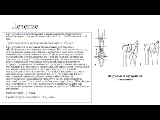 Лечение При переломах без смещения отломков кисть и предплечье иммобилизуют гипсовой