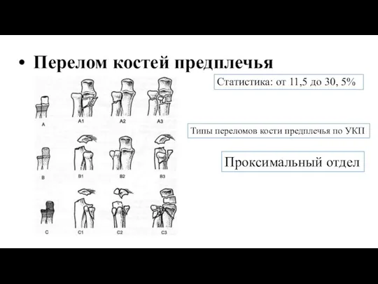 Перелом костей предплечья Статистика: от 11,5 до 30, 5% Типы переломов