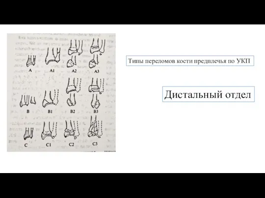 Типы переломов кости предплечья по УКП Дистальный отдел