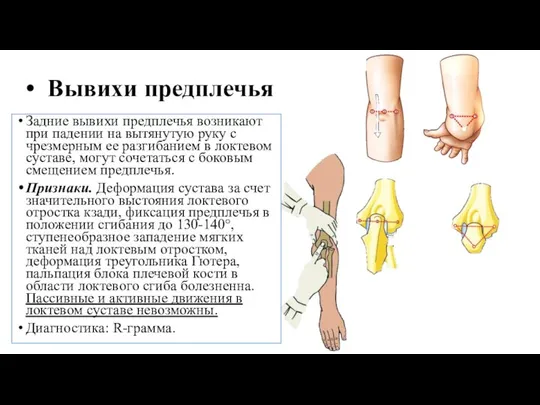 Вывихи предплечья Задние вывихи предплечья возникают при падении на вытянутую руку