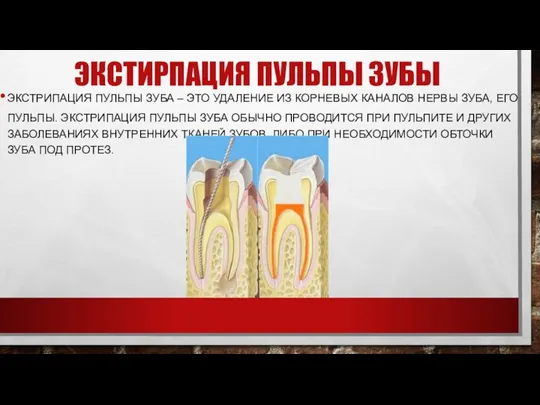 Экстирпация пульпы зубы Экстрипация пульпы зуба – это удаление из корневых