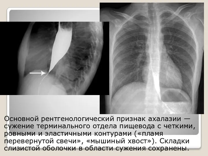 Основной рентгенологический признак ахалазии — сужение терминального отдела пищевода с четкими,