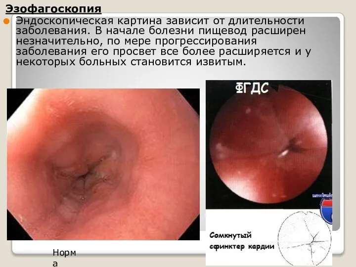 Эзофагоскопия Эндоскопическая картина зависит от длительности заболевания. В начале бо­лезни пищевод