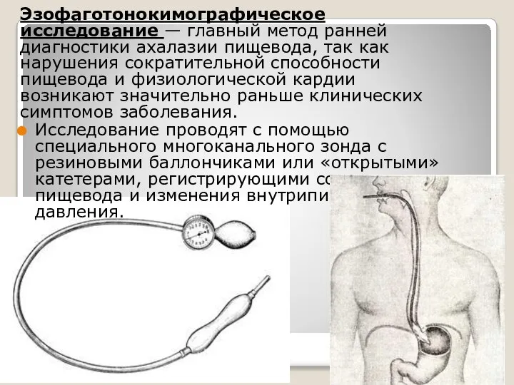 Эзофаготонокимографическое исследование — главный метод ранней диагностики ахалазии пищевода, так как