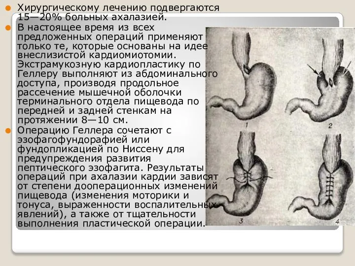 Хирургическому лечению подвергаются 15—20% больных ахалазией. В настоящее время из всех