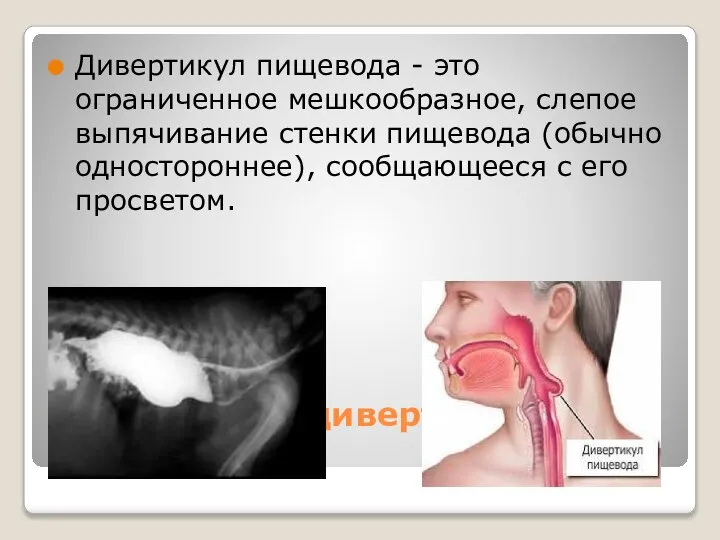 Определение дивертикула пищевода Дивертикул пищевода - это ограниченное мешкообразное, слепое выпячивание